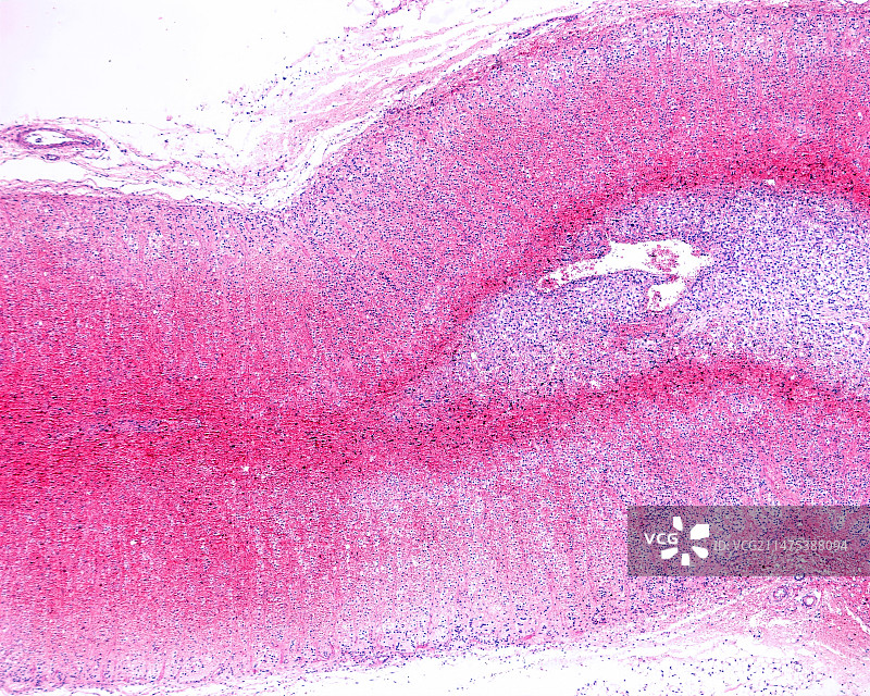 沃特豪斯-弗里德里希森综合征，光学显微照片图片素材
