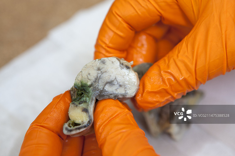 肠癌标本图片素材