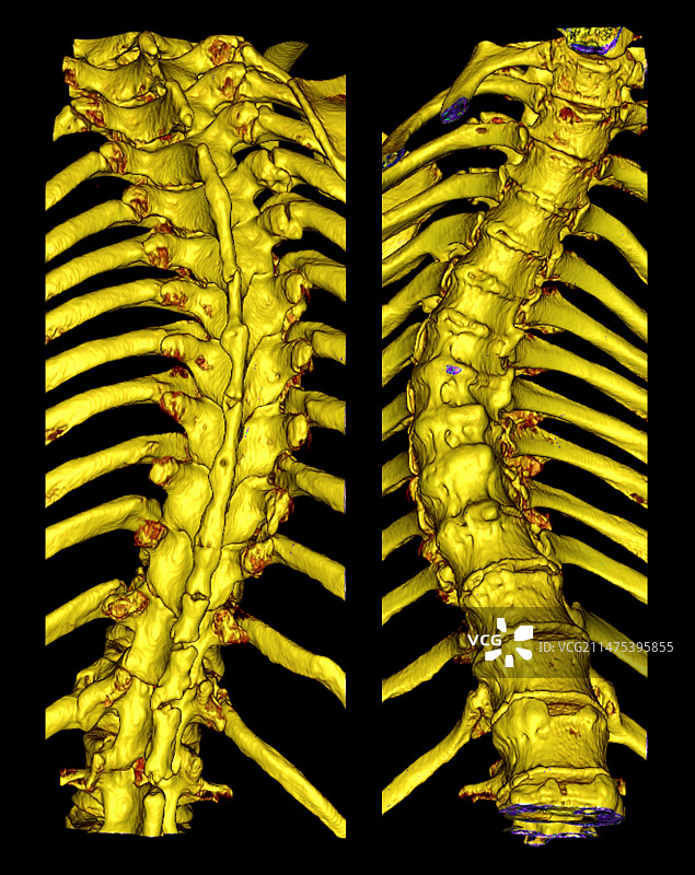 胸椎脊柱侧弯3D CT扫描图片素材