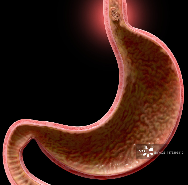 食管癌示意图图片素材