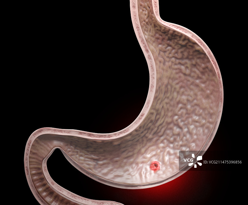 胃溃疡插图图片素材
