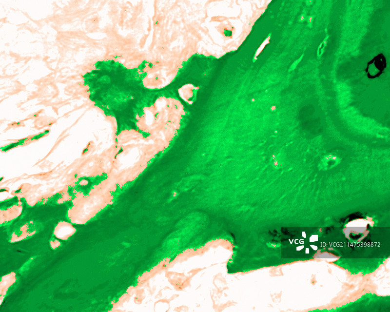 巨细胞骨肉瘤荧光显微照片图片素材