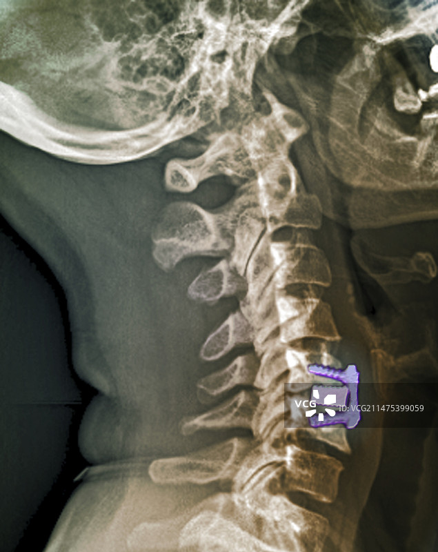 颈椎间盘植入X光片图片素材