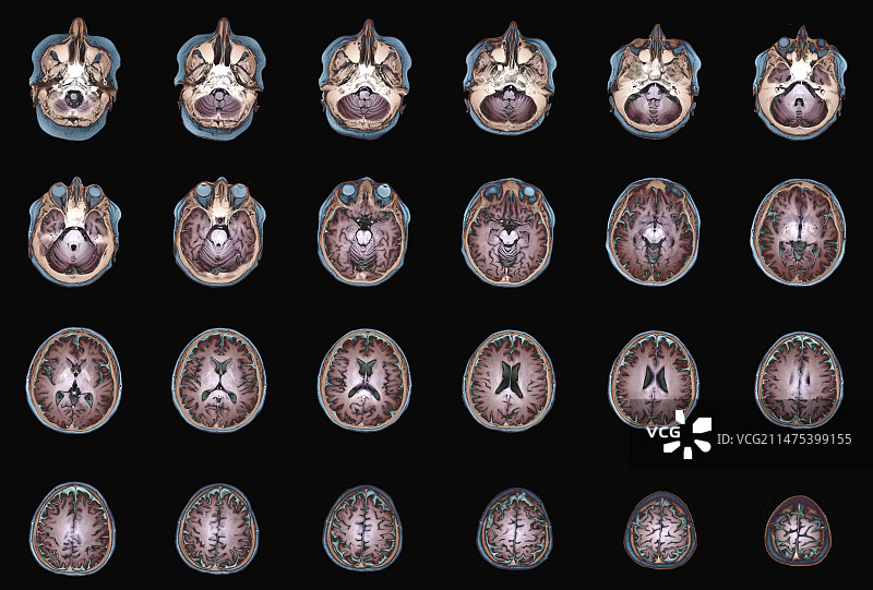 人脑解剖结构核磁共振扫描图图片素材