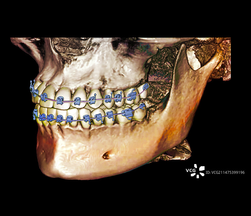 正畸牙套3D锥形CT扫描图片素材