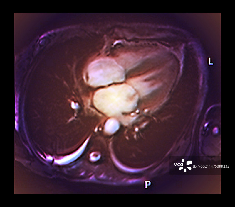 心脏二尖瓣渗漏核磁共振扫描图片素材