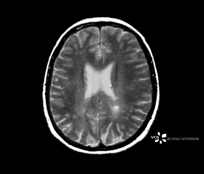 莱姆脑病核磁共振扫描图片素材