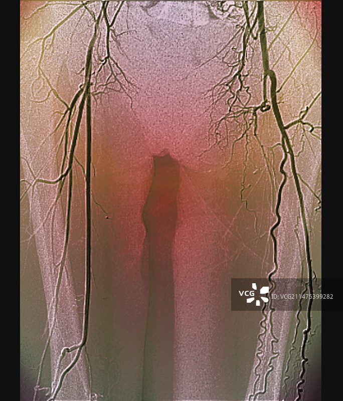 股动脉阻塞，X光片图片素材