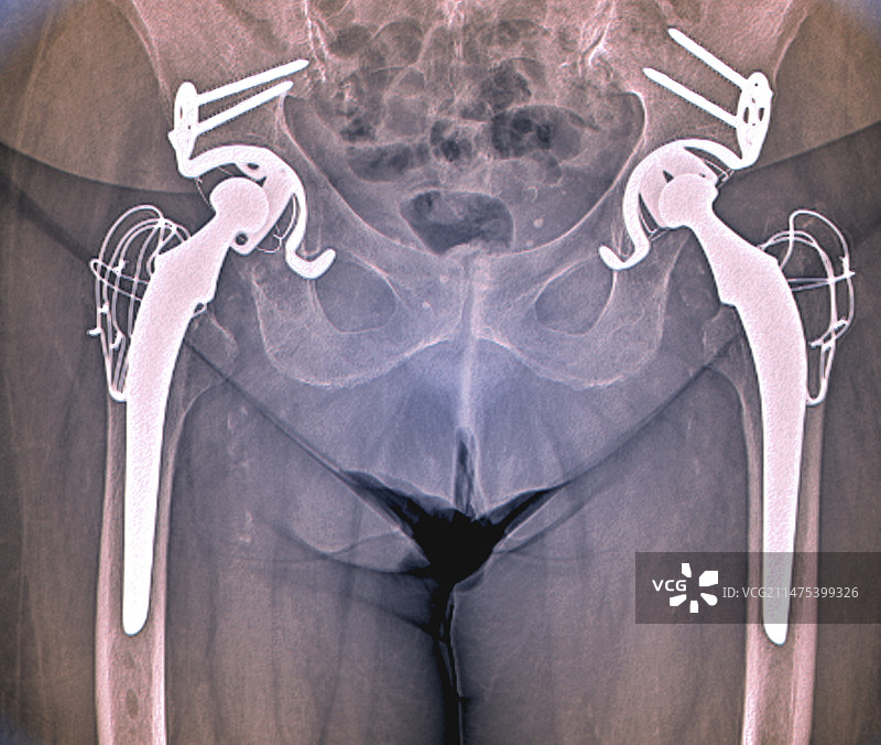 双侧髋关节置换X光片图片素材