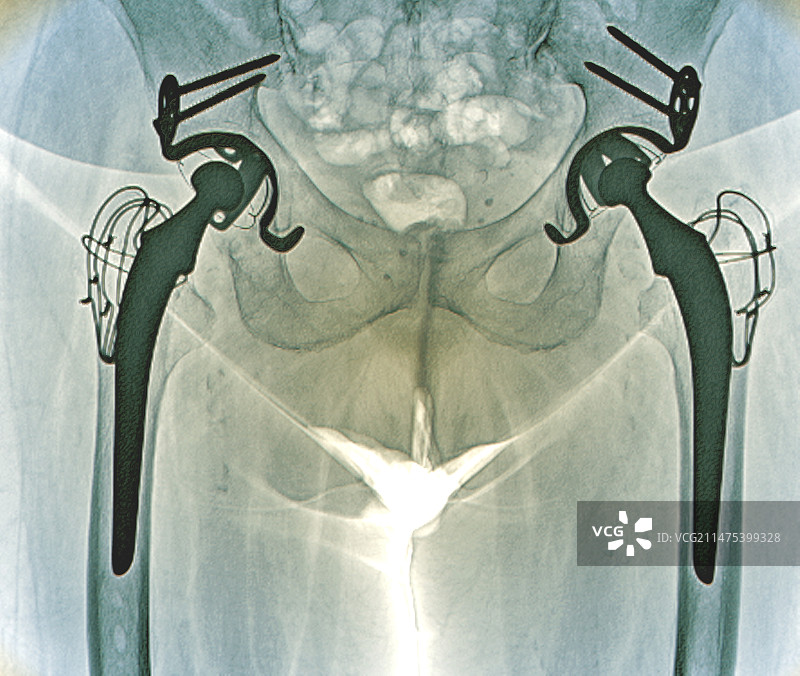 双侧髋关节置换X光片图片素材