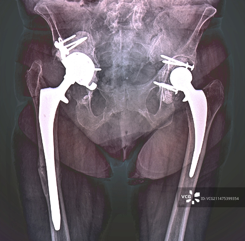 双侧髋关节置换X光片图片素材