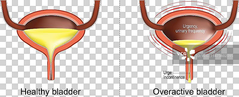 膀胱过度活动症导致膀胱失控图片素材