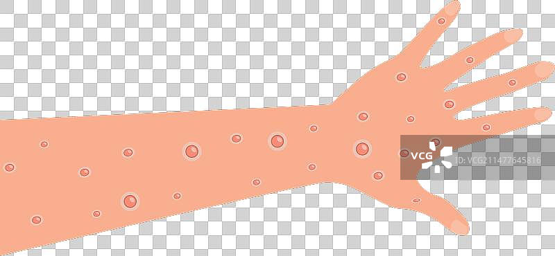 手和手臂上的猴痘病毒伤口图片素材