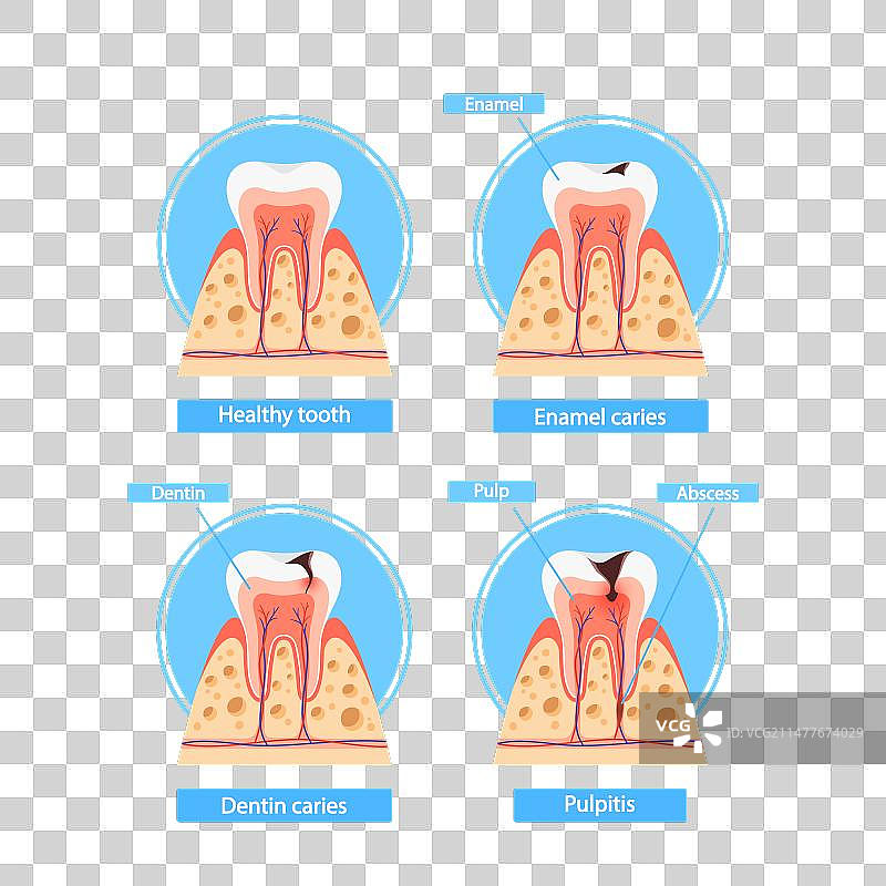 龋齿阶段信息图：健康的牙釉质图片素材