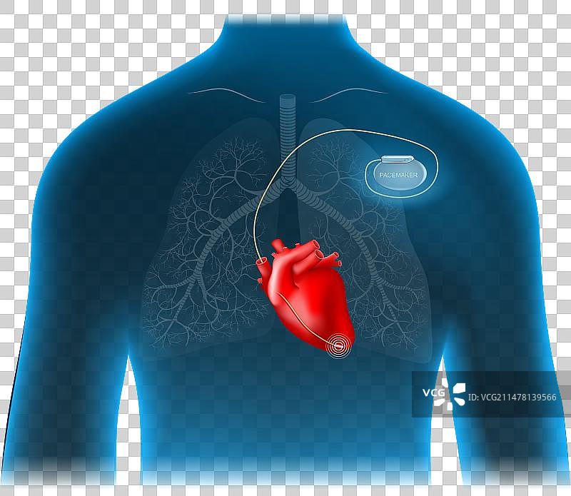心脏起搏器位置图片素材