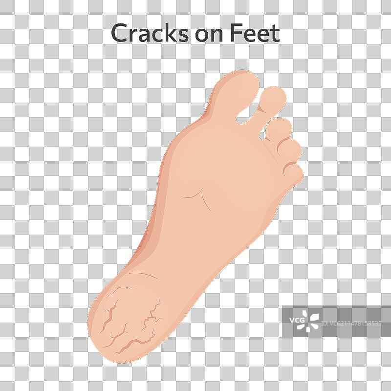脚部裂纹设计图片素材