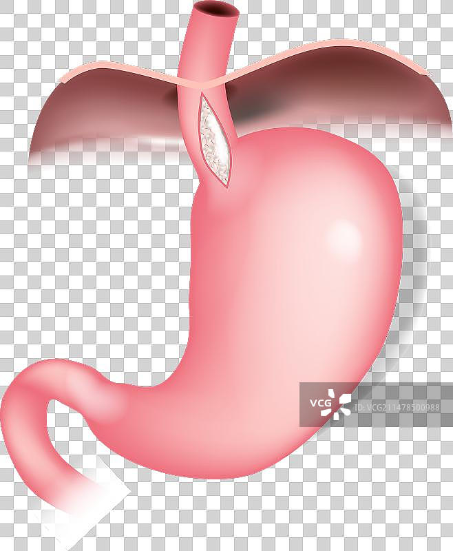 腹腔镜下Heller肌切开术图片素材