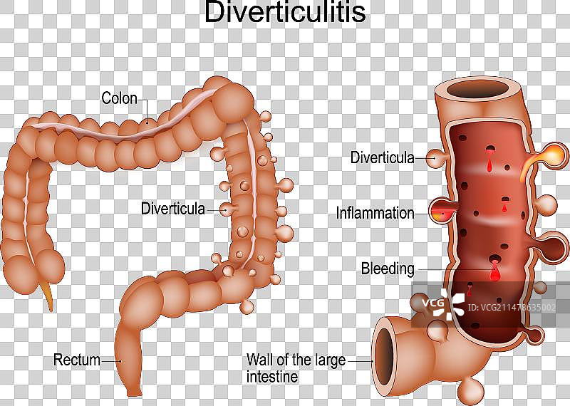 结肠憩室炎图片素材