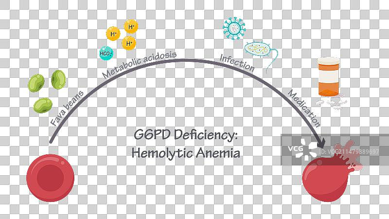 G6PD缺乏症溶血性贫血图片素材
