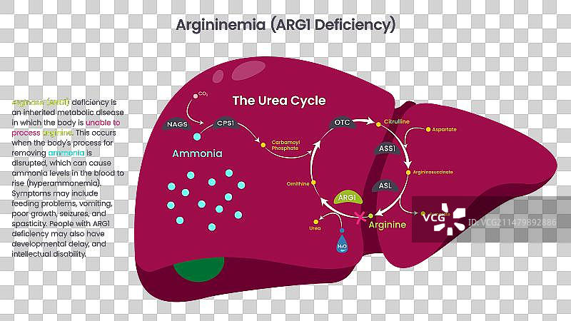 精氨酸血症精氨酸酶ARG1缺乏症图片素材