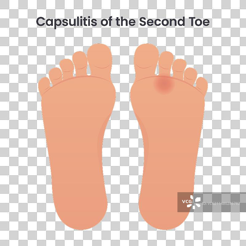 第二脚趾的关节囊炎图片素材
