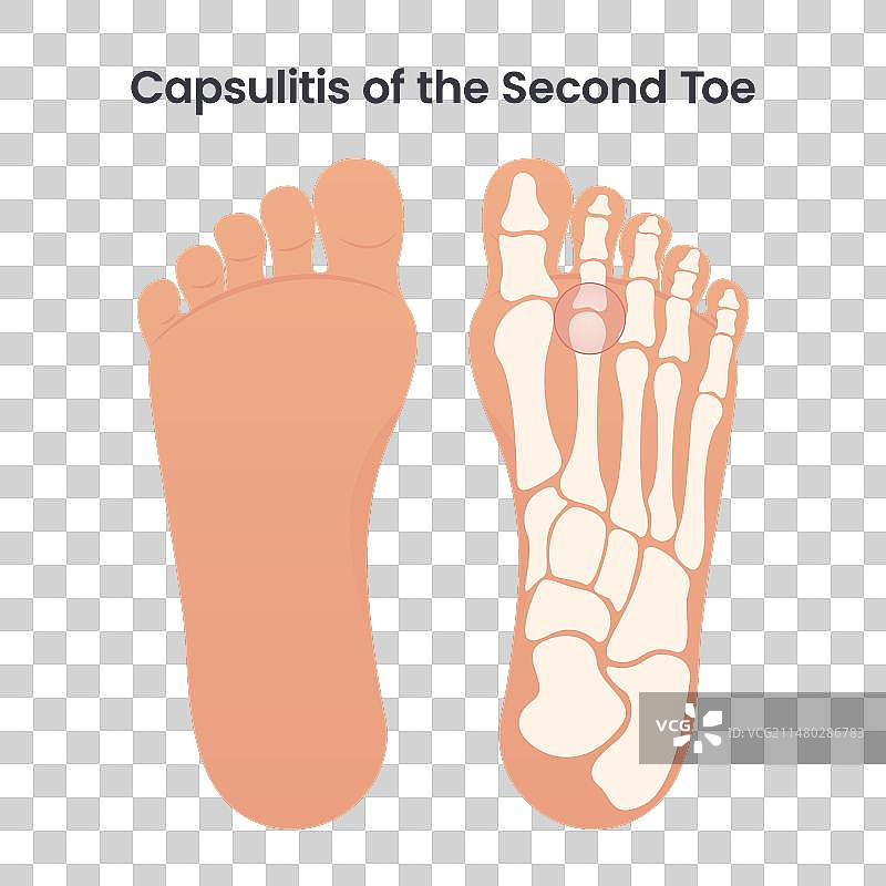 骨性关节囊炎图片素材