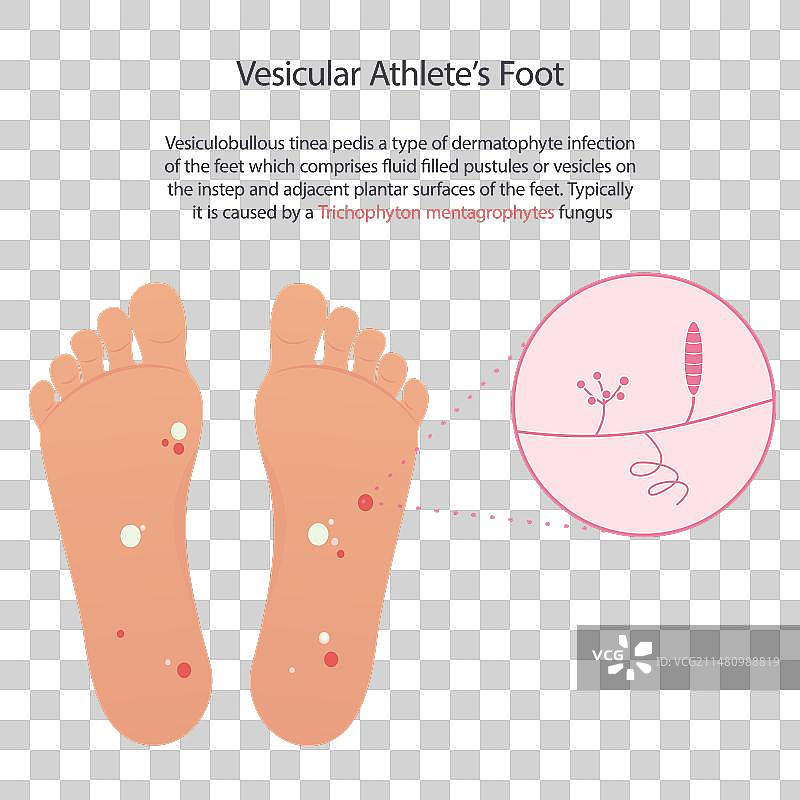 水疱型脚癣科普图片素材