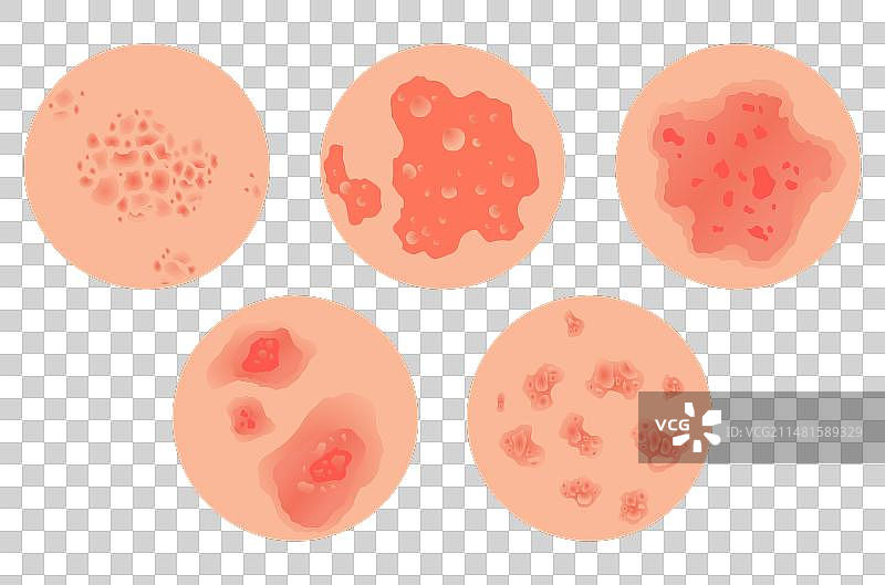 不同类型的银屑病集合图片素材