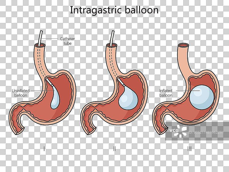 胃内球囊结构医疗示意图片素材