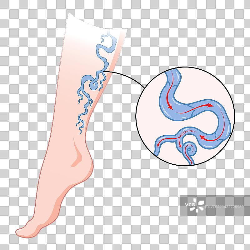 静脉曲张：可见蓝色血管图片素材