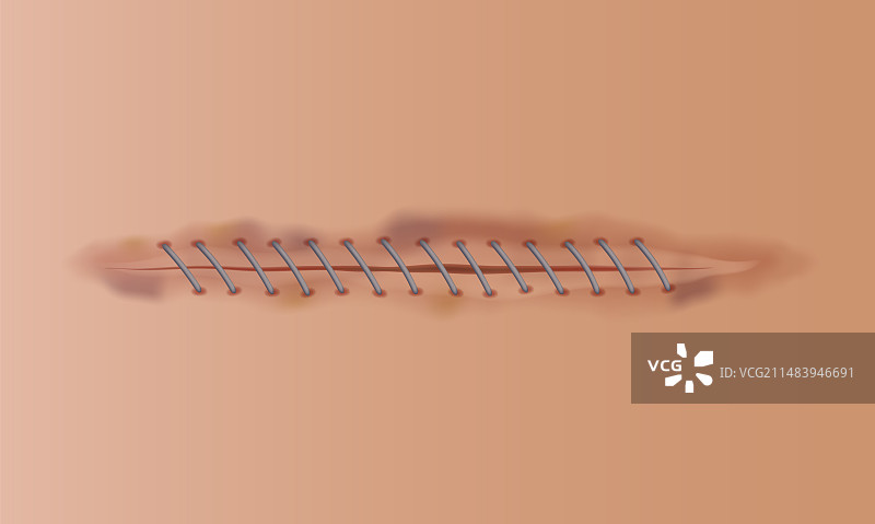 皮肤伤口疤痕缝合图片素材