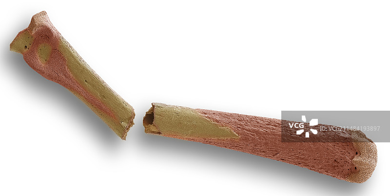 骨质疏松骨骼的扫描电子显微镜图片素材