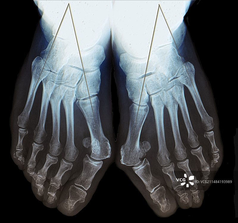 拇囊肿评估，X光片图片素材