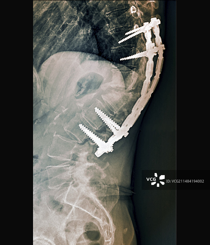 脊柱后凸植入物X光片图片素材