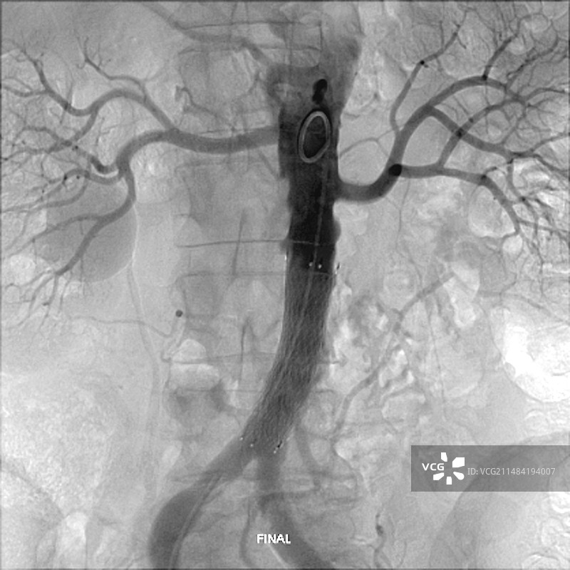 主动脉支架的最终位置，X光片图片素材