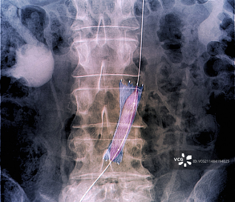 主动脉支架扩张X光片图片素材