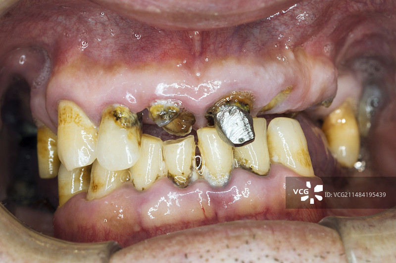 牙科脓肿图片素材