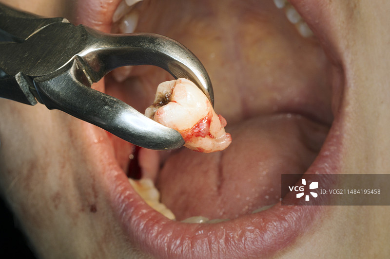 拔智齿图片素材