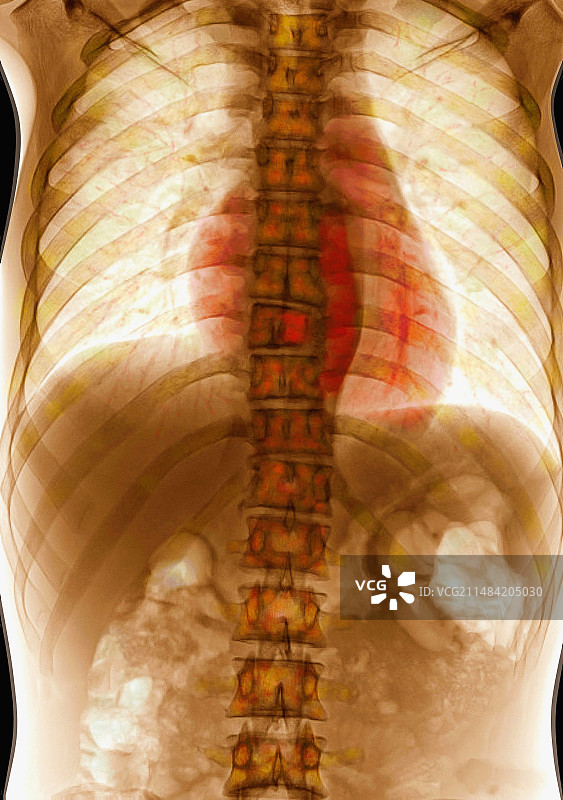 心、肺和肠的X光片图片素材