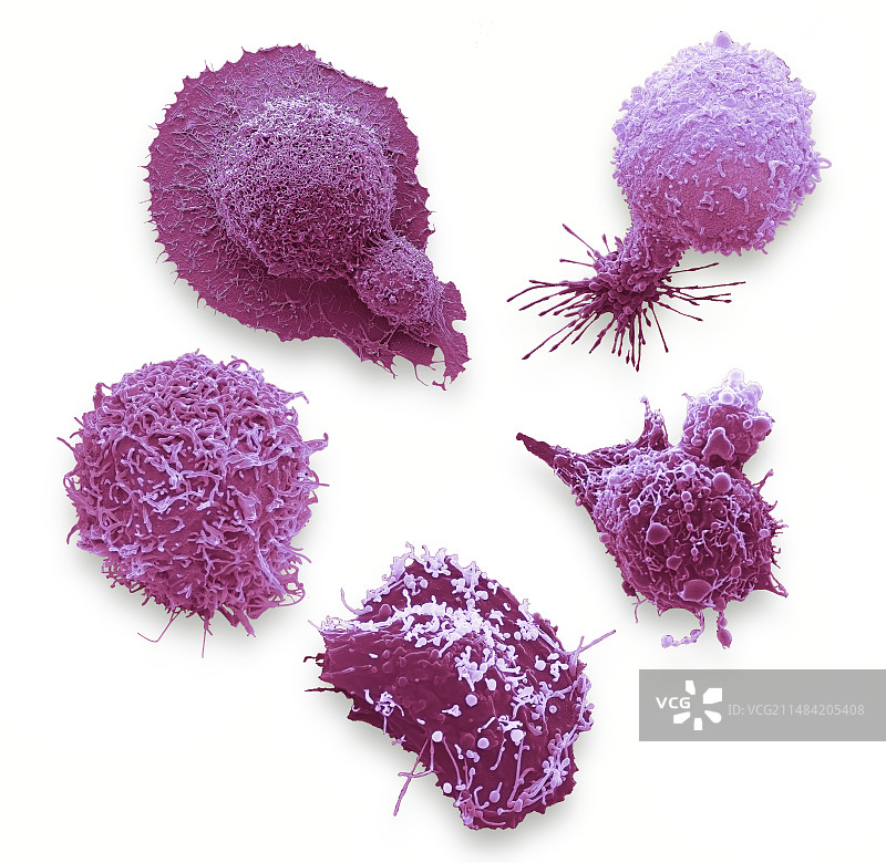 最常见的男性癌症细胞，扫描电镜图片素材