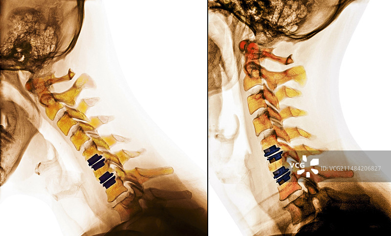 颈椎中的人造椎间盘，X光片图片素材