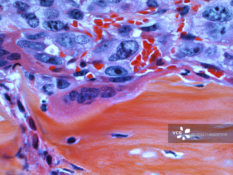 转移性骨癌显微照片图片素材