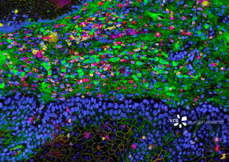 宫颈癌研究图片素材