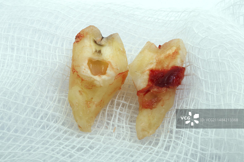 拔出的智齿图片素材