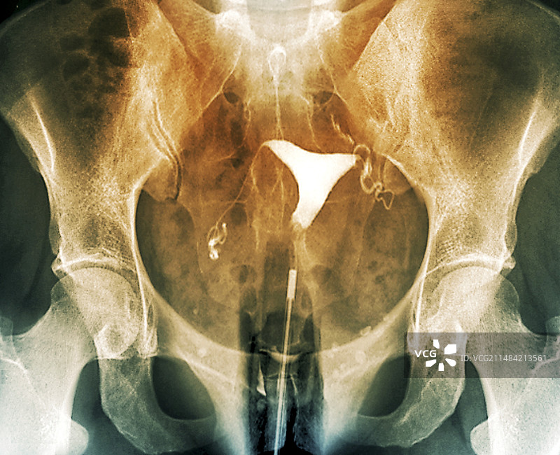 女性生殖系统X光片图片素材