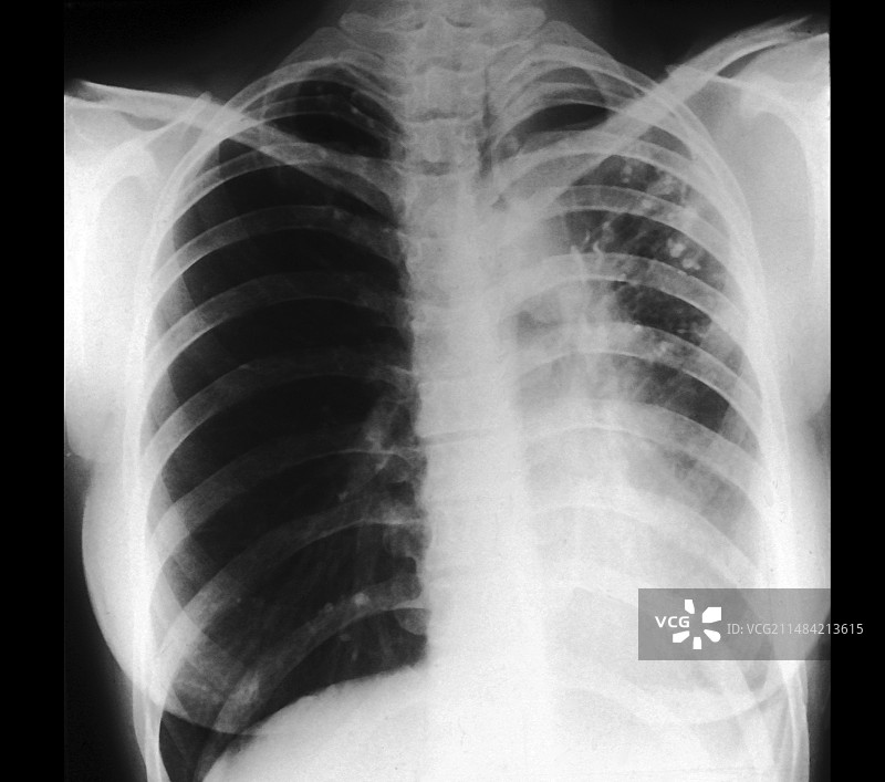 支气管扩张X光片图片素材