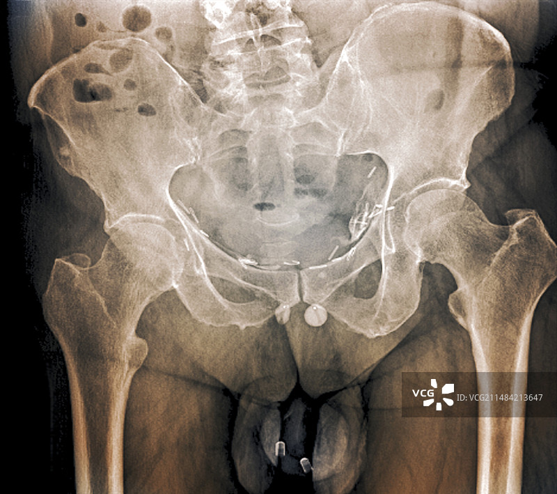 尿失禁植入物X光片图片素材