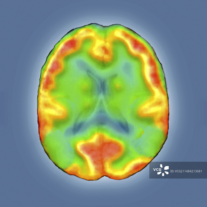阿尔茨海默病患者的大脑SPECT图像图片素材
