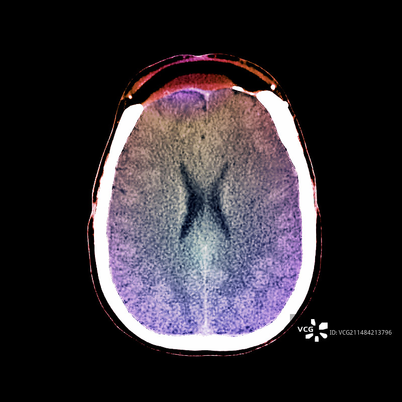 重建手术后的骷髅CT图图片素材