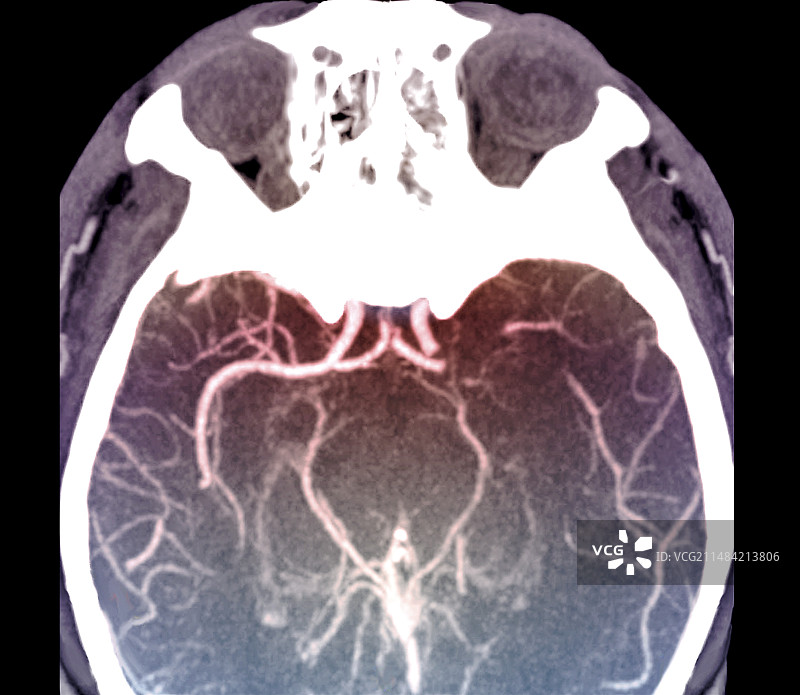 中风患者的大脑，CT扫描图片素材